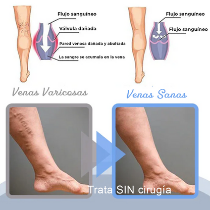 MEDix™ Lenisce le vene Max