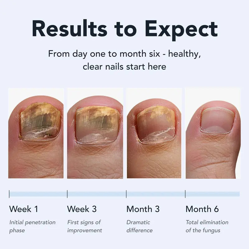 [Oficial de Lunavia] Bolígrafo antifúngico - ÁCIDO UNDECILÉNICO 25% - Cura a maioría dos pés de atleta, comezón muscular e tiña.